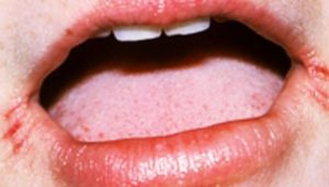 Free Download Cracks At Mouth Corners Vitamin Deficiency